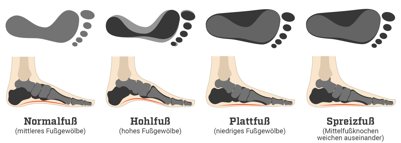 deinsportsfreund-infografik-futfehlstellungen-desktop.jpg